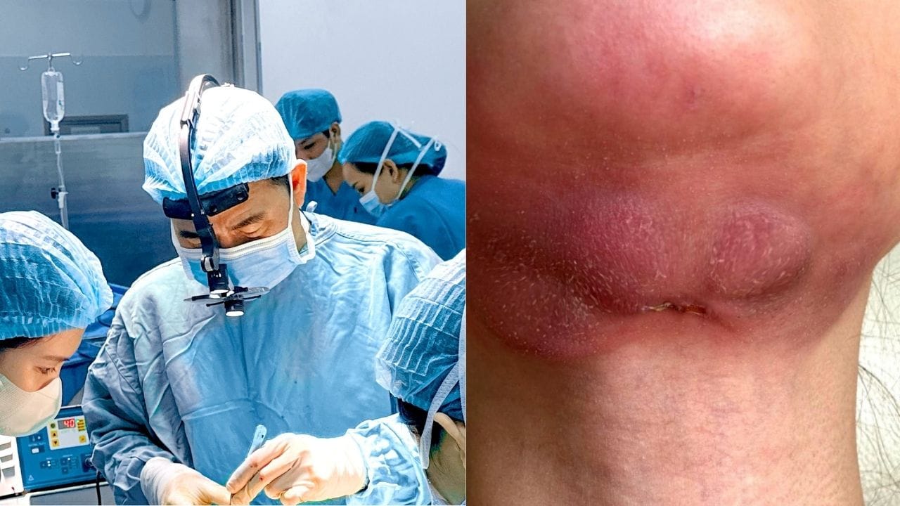 Hút mỡ mặt có nguy hiểm không? Cách phòng tránh hiệu quả