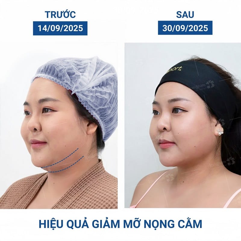 Khách hàng sở hữu khuôn mặt cân đối, thon gọn sau hút mỡ nọng cằm