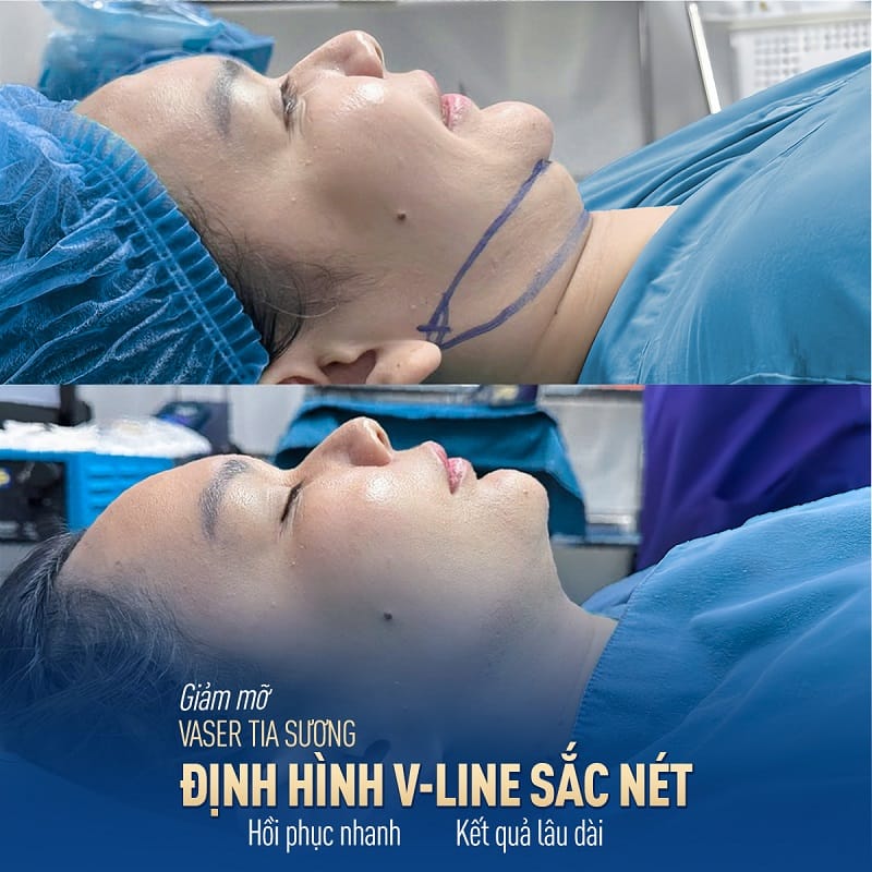Giảm mỡ vaser tia sương định hình cằm vline an toàn