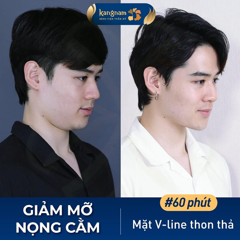 Hút mỡ nọng cằm đúng quy trình sẽ đảm bảo an toàn cho khách hàng