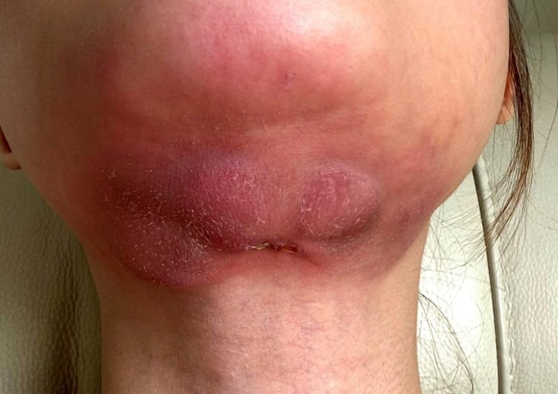 Việc hút mỡ sai cách sẽ gây tổn thương, biến dạng vùng cằm