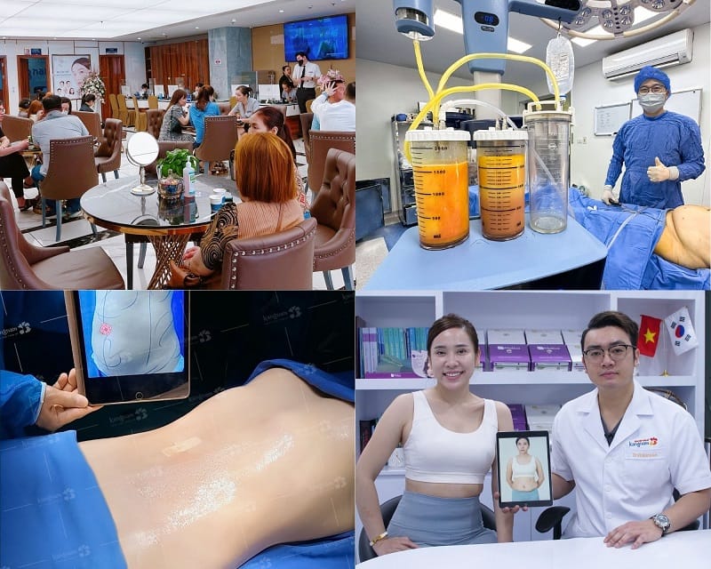 Bệnh viện Thẩm mỹ Kangnam là địa chỉ hút mỡ được nhiều khách hàng lựa chọn tại TPHCM