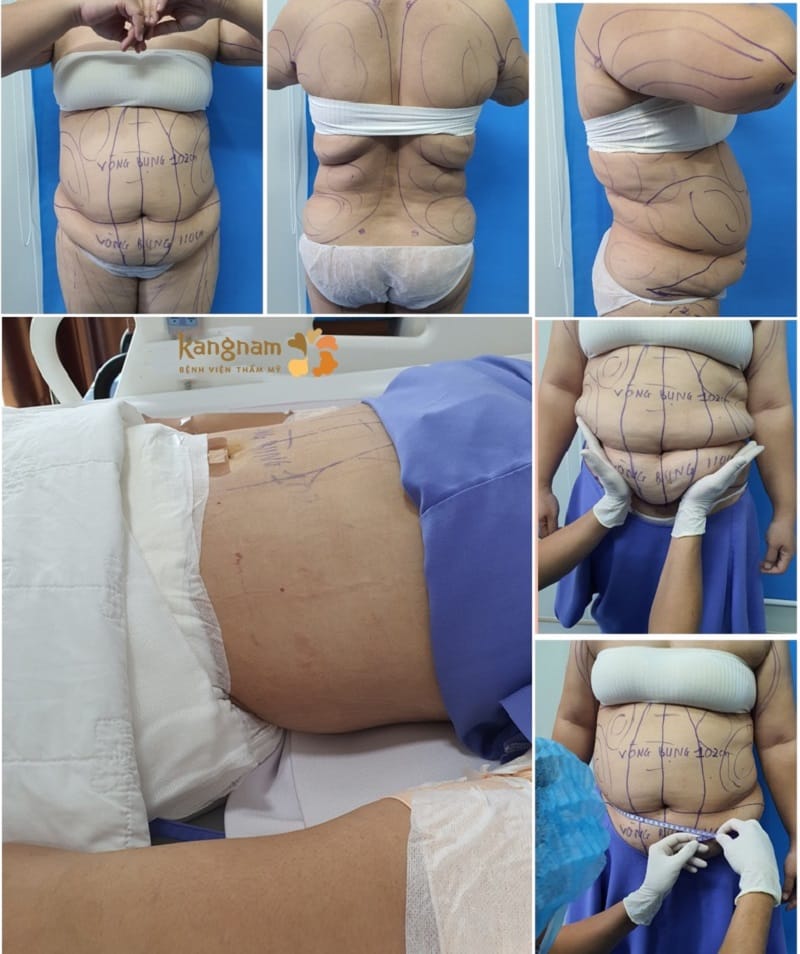 Chi phí hút mỡ toàn thân có sự thay đổi rõ rệt