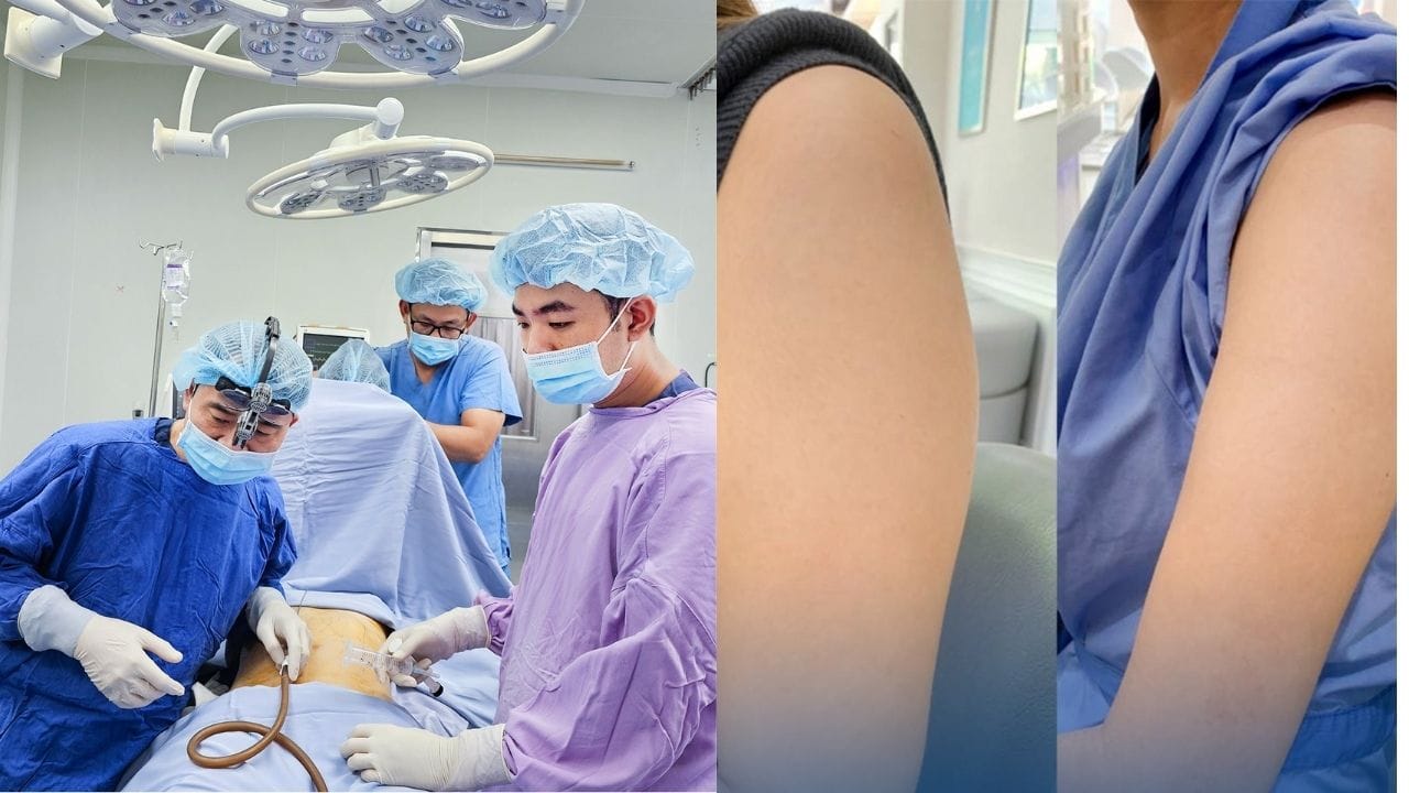 Hút mỡ toàn thân là gì? Những lợi ích khi hút mỡ