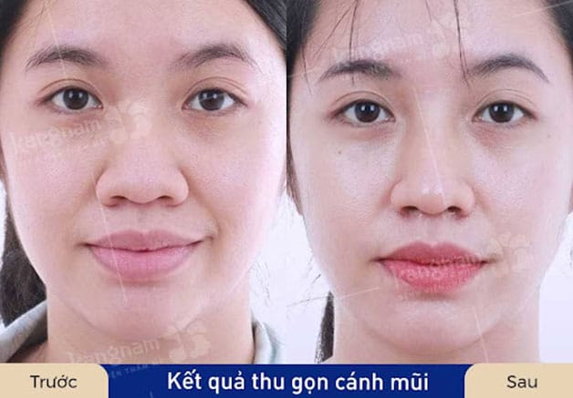 Cắt cánh mũi tạo gương mặt thon gọn