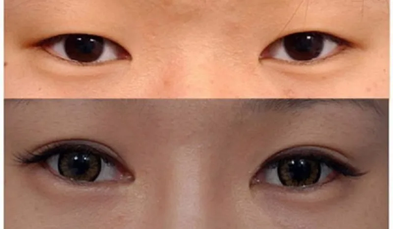 Double eyelids with a distinct crease; large, round eyes. 