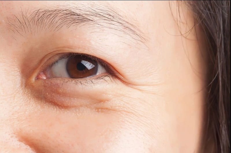 Những người lớn tuổi có nếp mí dễ bị nhầm với mắt 2 mí