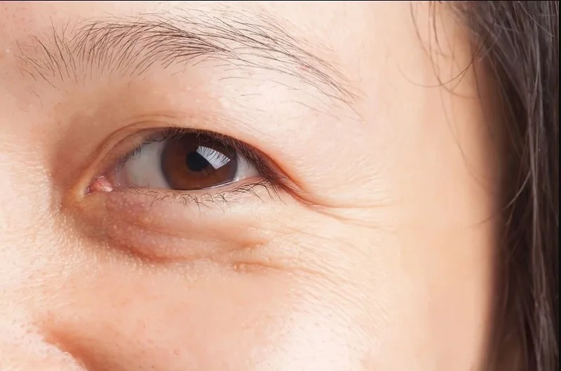 Older adults with certain eyelid creases can easily be mistaken for having double eyelids. 