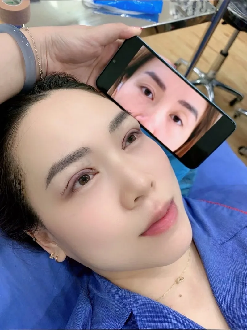 Eyelid surgery helps create well-defined, natural-looking double eyelids. 