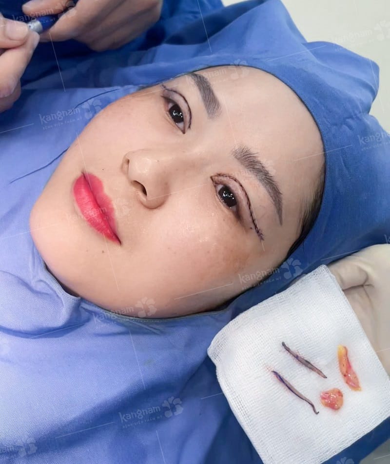 Mí mắt sẽ hết sưng tấy sau vài ngày