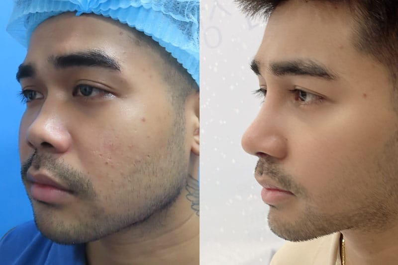 Cải thiện mũi hếch cho nam với chi phí hợp lý