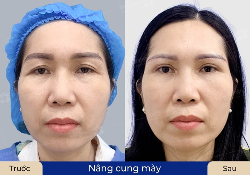 Nâng cung chân mày tại Kangnam giúp định hình lại chân mày cân đối, hài hòa
