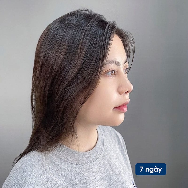 Mũi hồi phục tốt sau 7 ngày