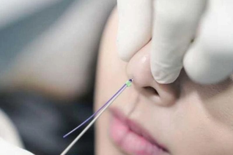 Căng chỉ mũi khá an toàn