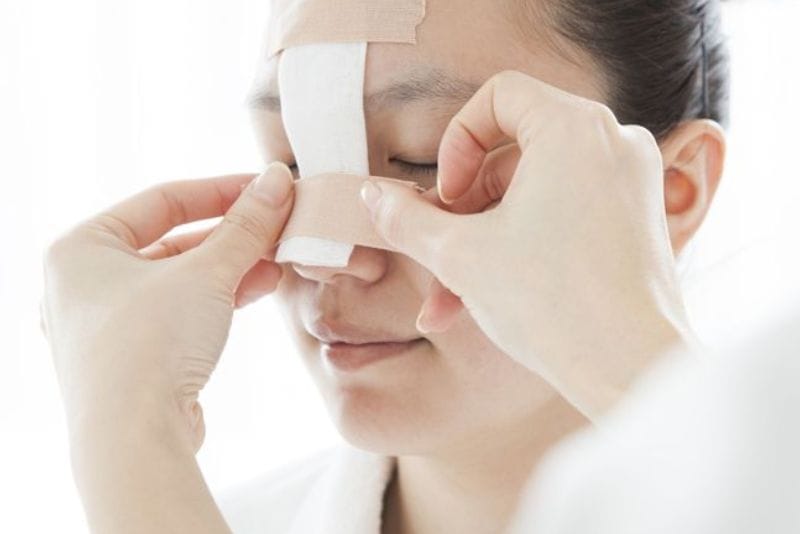 Rửa mặt ngay sau khi nâng mũi dễ gây sưng nề