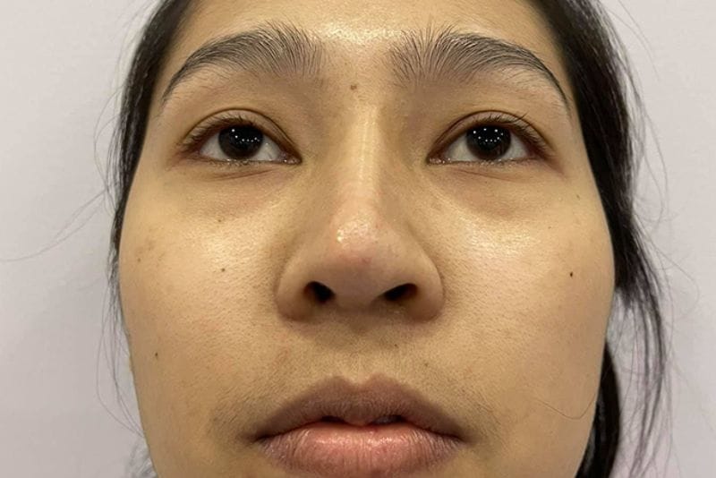 Mũi lệch do mô da mũi mỏng