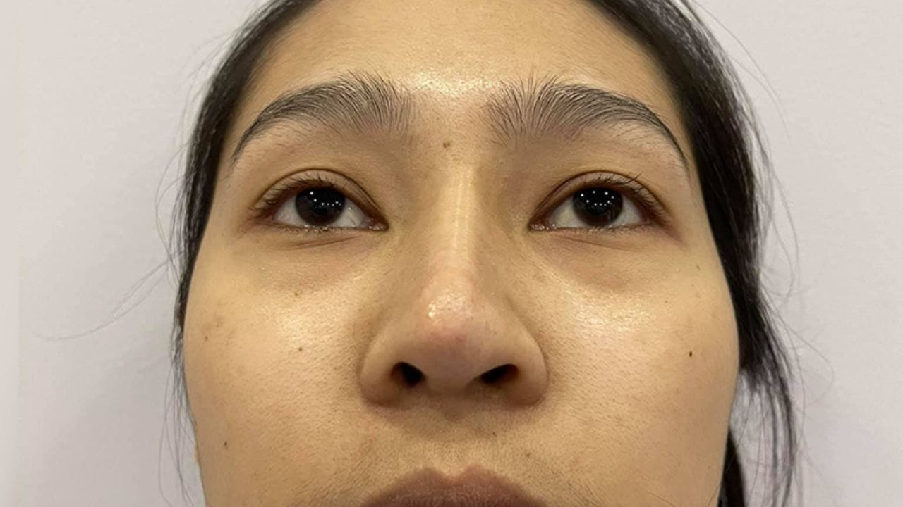 Nâng mũi bị lệch có nắn được không? 3 trường hợp có thể nắn chỉnh