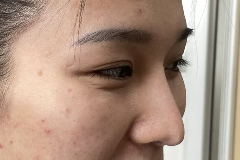 Tụt sụn do chăm sóc hậu phẫu sai cách