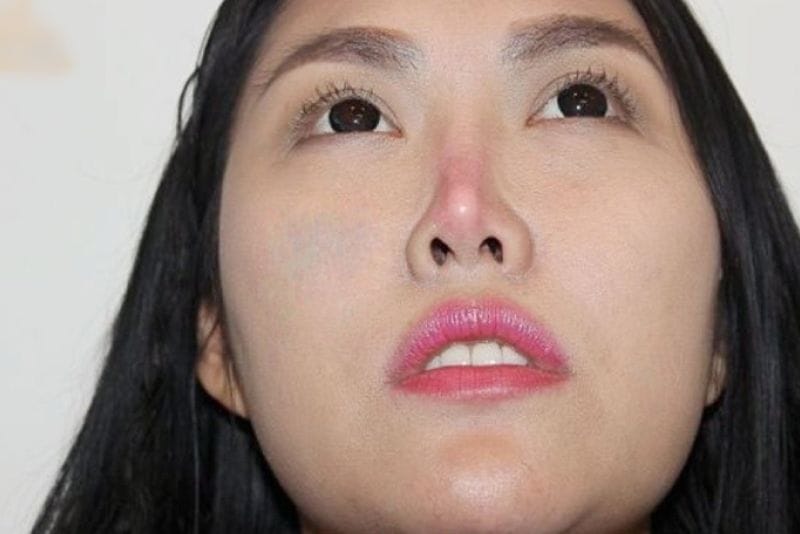 Mũi bóng đỏ, tê bì