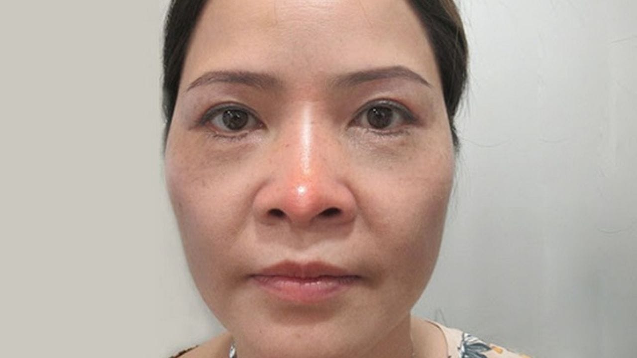 Nâng mũi cấu trúc có bị tụt sụn không? 5 dấu hiệu tụt sụn mũi dễ nhận biết