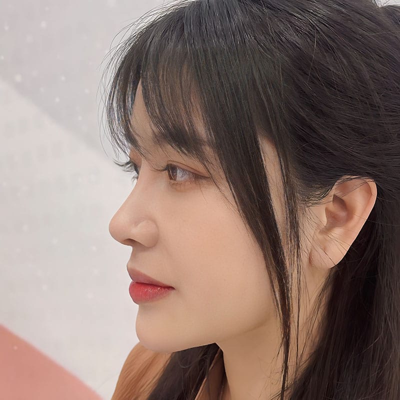 Nâng mũi sụn sườn duy trì kết quả lâu dài