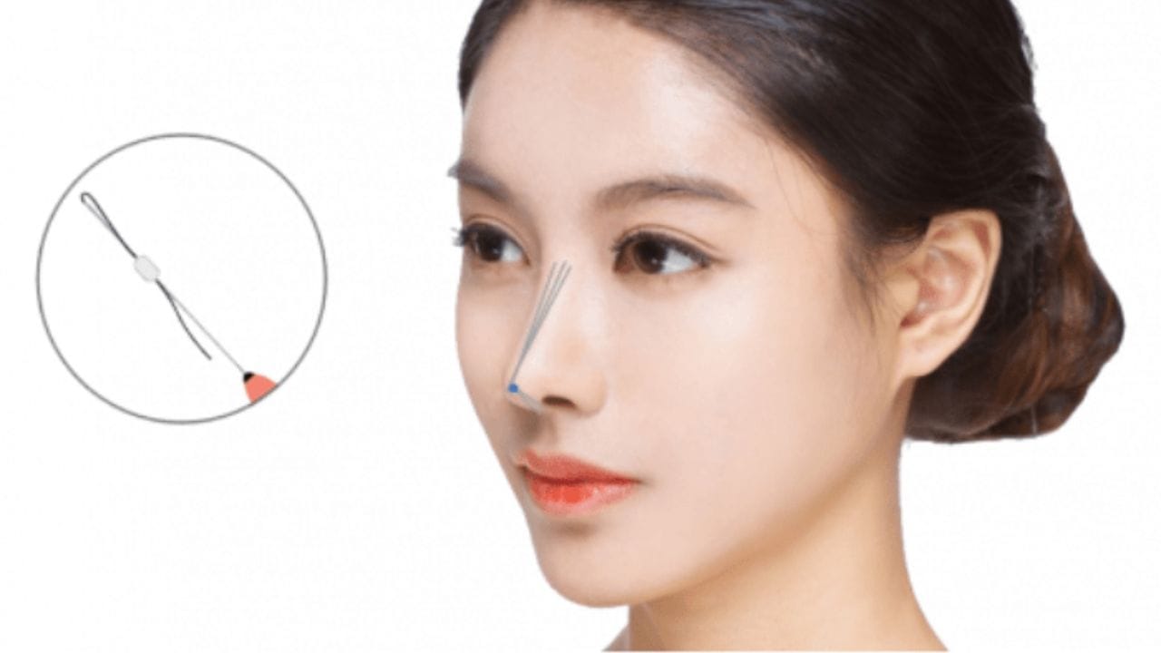 Nâng mũi chỉ là gì? Ưu và nhược điểm sau khi căng chỉ nâng mũi