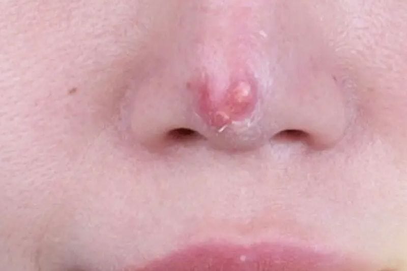 Đỏ đầu mũi do phản ứng sụn