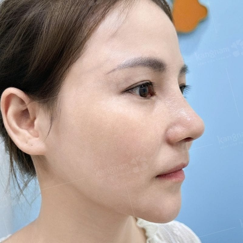 Khách hàng sở hữu mũi cao mềm mại, tự nhiên