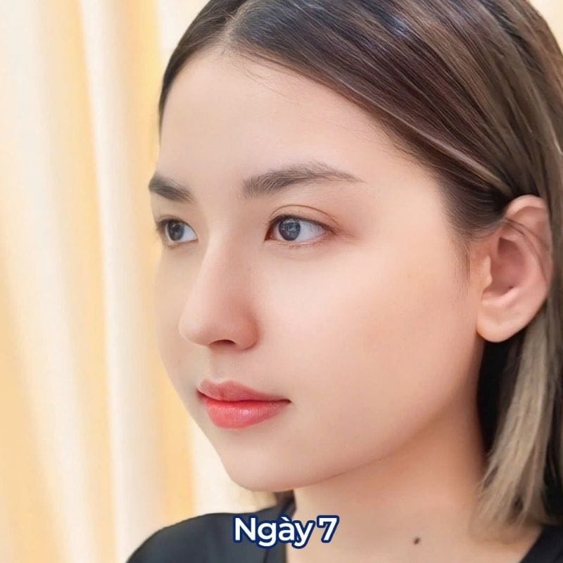 Khách hàng tái khám và cắt chỉ, mũi đã ổn định cơ bản