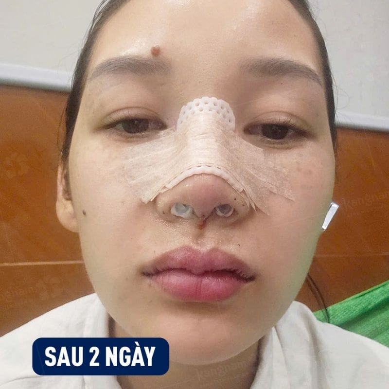 Cách chăm sóc hậu phẫu cũng ảnh hưởng đến độ bền sau nâng mũi