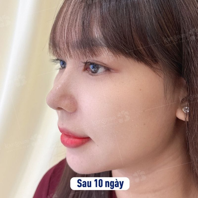 Người bị viêm xoang