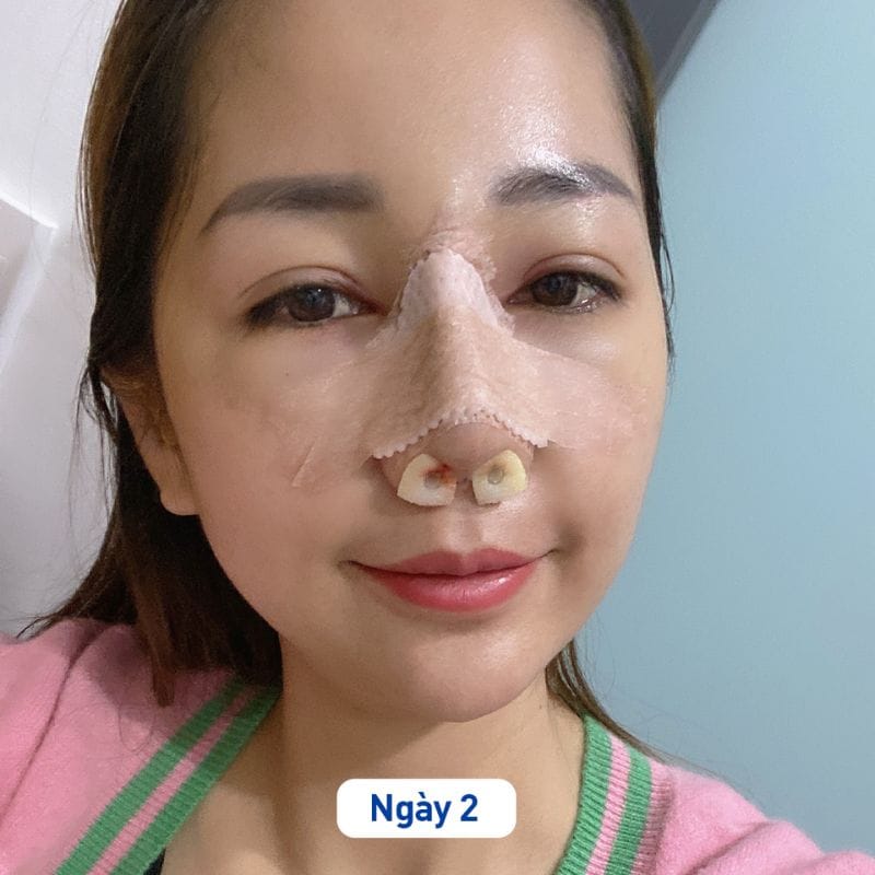 Giữ vùng mũi khô ráo sau phẫu thuật