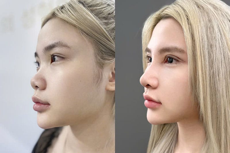 Khắc phục mũi ngắn hếch toàn diện