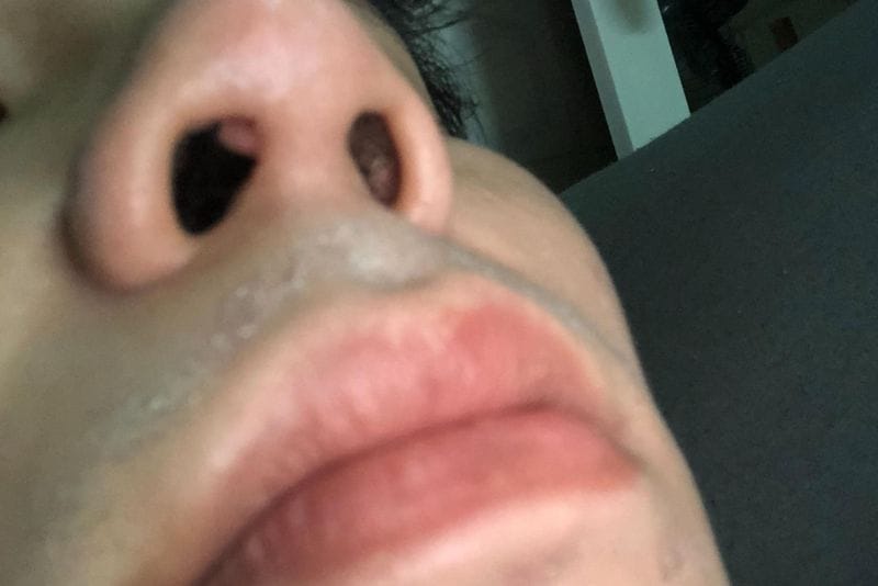 Nổi cục trong lỗ mũi do nhiều nguyên nhân gây ra