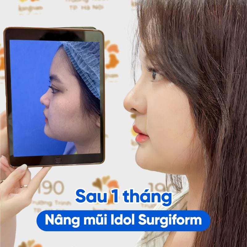 Dáng mũi ổn định sau 1 tháng