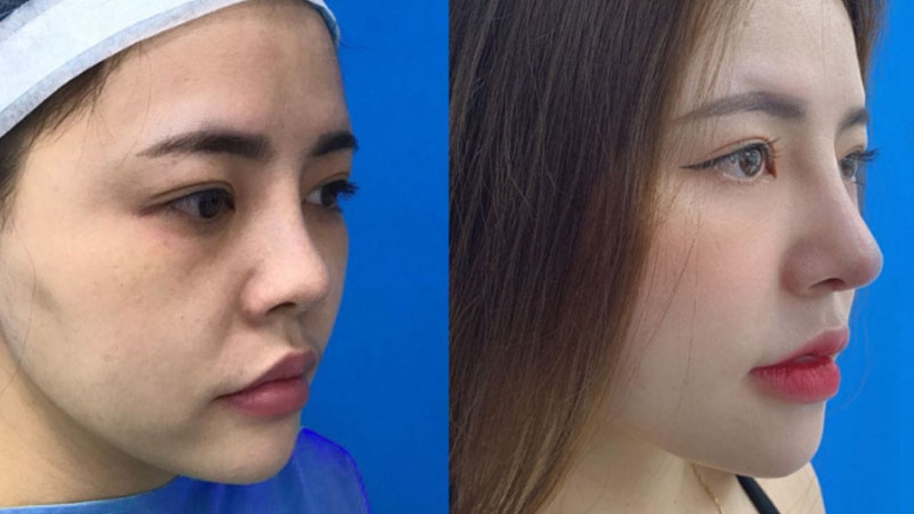 Nâng mũi sụn nhân tạo có vĩnh viễn không? Cách duy trì kết quả nâng mũi