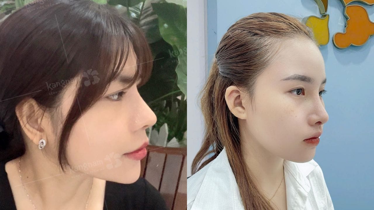 Nâng mũi sụn sườn có bị teo lại không? Đối tượng phù hợp nâng mũi sụn sườn