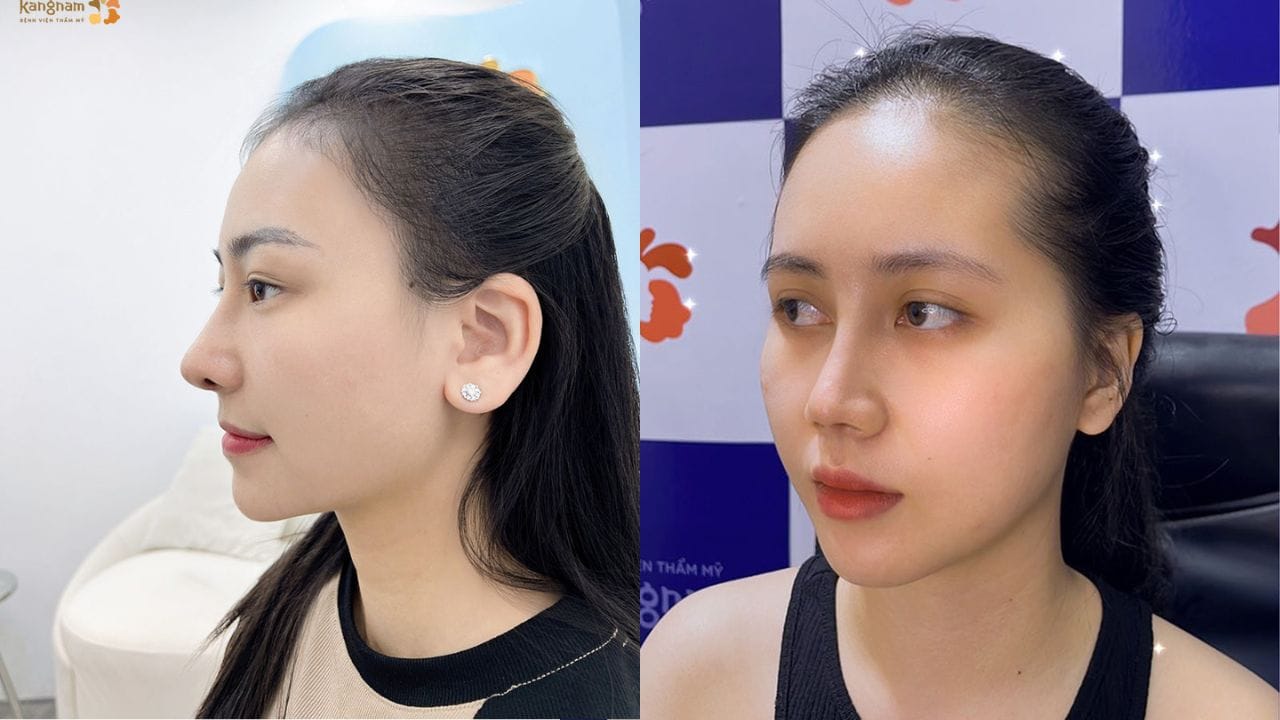 Nâng mũi sụn tự thân có vĩnh viễn không? So sánh với sụn nhân tạo