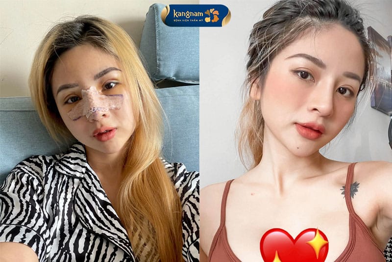 Dáng mũi cân đối, hài hòa