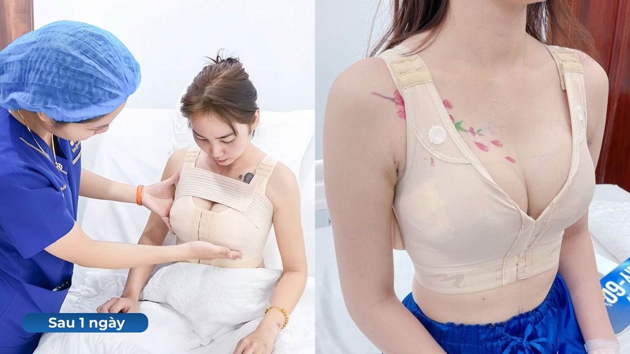 Nâng ngực bao lâu thì lành? Cách chăm sóc để ngực nhanh hồi phục