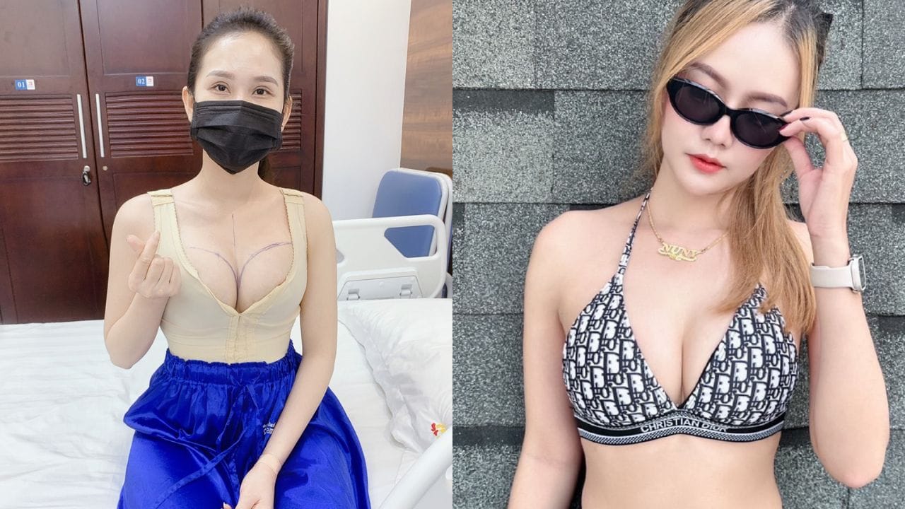 Nâng ngực bao lâu thì mềm? Các giai đoạn phục hồi sau nâng ngực