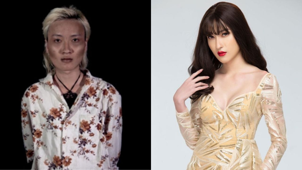 Nâng ngực cho người chuyển giới có gì khác so với nữ giới?