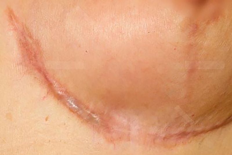 Sẹo xấu sau nâng ngực do bác sĩ thực hiện sai kỹ thuật