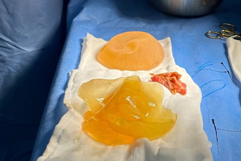 Tình trạng bao xơ nặng