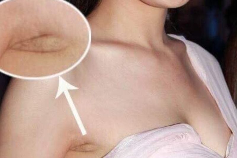 Đường sẹo ở nách không lộ