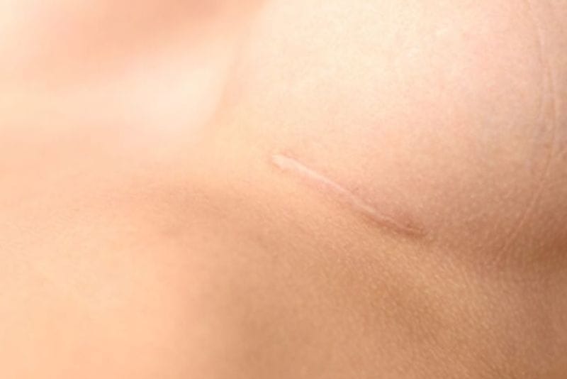 Chăm sóc tốt giúp sẹo mờ nhanh