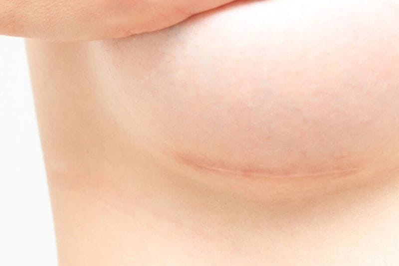 Sẹo nâng ngực là điều khó tránh khỏi