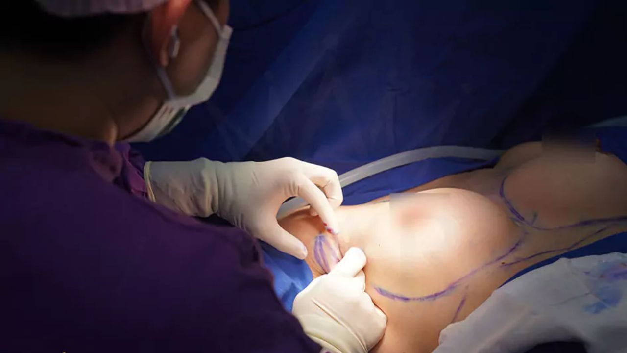 Nâng ngực đường nách là gì, có đau không và những lưu ý quan trọng