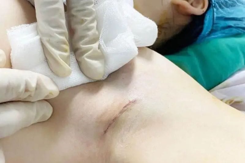 Nâng ngực đường nách giảm sẹo tối đa