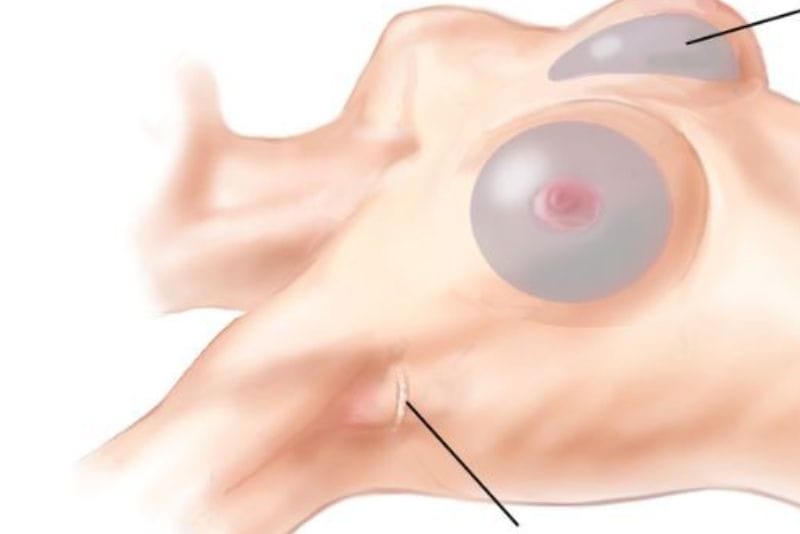 Nâng ngực đường nách có đau không?